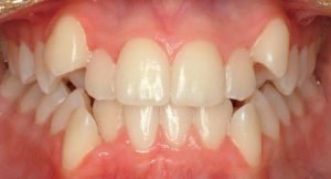 do i need braces for an overbite